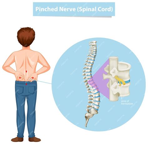 Free Vector Diagram Showing Man And Pinched Nerve