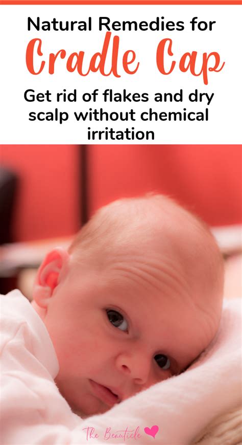 Natural Remedies For Cradle Cap And Baby Dry Scalp Cradle Cap