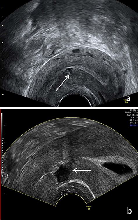 Uterine Scar Dehiscences Cases 1 And 2 Tvus Image A Shows A Light