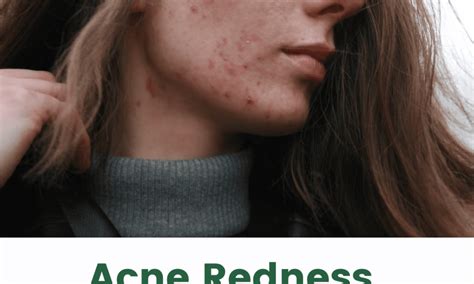 Acne Redness Causes Treatment And Prevention Healthishlife