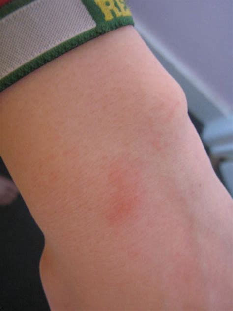 Day 38 Dry Skin On Arms Accutane Progress Gallery Forums