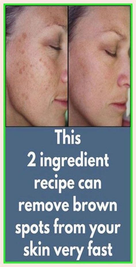This Is A Splendid Info Brown Spots On Skin Skin Spots Dark Spots On Face Dark Patches On