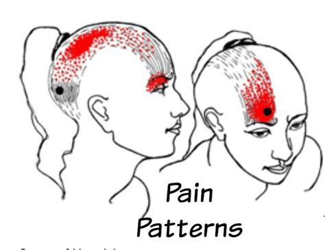 Pin By Christina Sowers Moran On Occipital Neuralgia Trigger Points