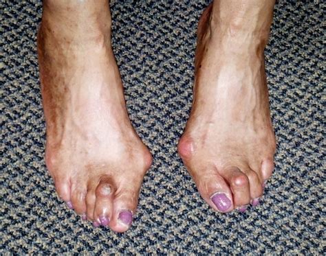 Foot Deformities Align Your Anklebones
