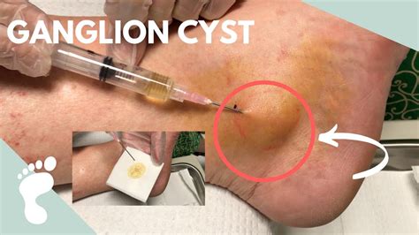 Draining A Ganglion Cyst Using A Syringe Youtube