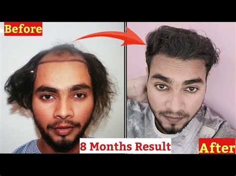 Months Result Of My Hair Transplant Ganesh Thakur YouTube