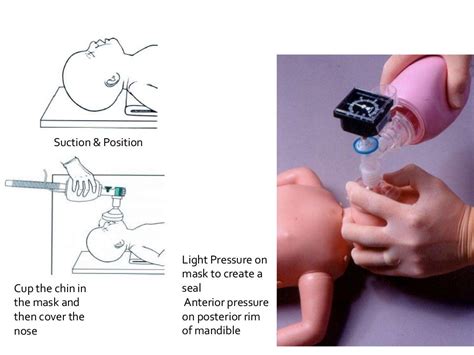 Neonatal Resuscitation Programme Nrp