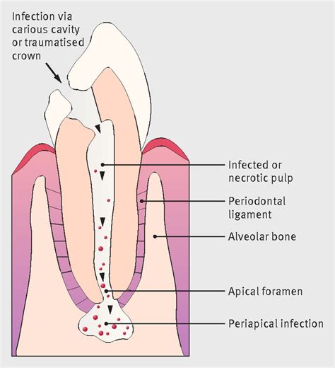 Management Of Severe Acute Dental Infections The Bmj