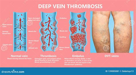 Deep Vein Thrombosis Blood Clots Treatments In Phoenix Az Bank Home Com