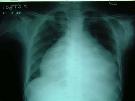 Clinical Manifestations Of Pericarditis And Pericardial Effusions Its Complications And