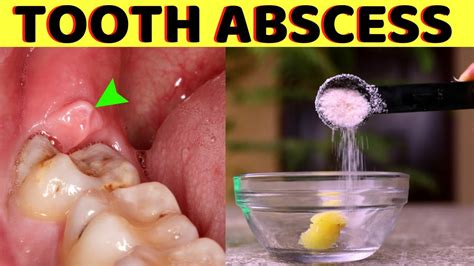 How To Get Rid Of A Tooth Abscess Without Going To The Dentist Gum