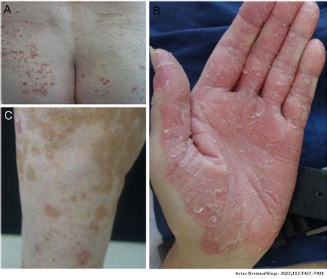 Translated Article Psoriasis And Anti Pd 1 And Anti Pd L1