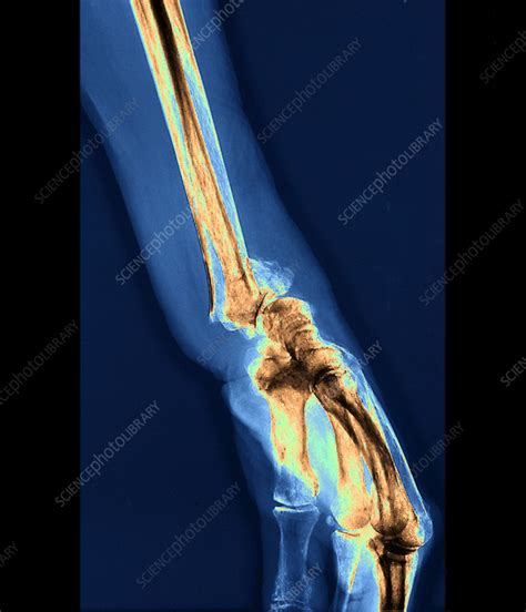 Wrist Fracture X Ray Stock Image C0551183 Science Photo Library