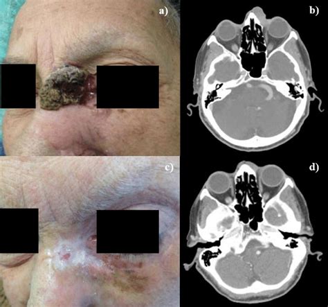 Basal Cell Carcinoma Of Nasal Root And Internal Canthus Of Left Eye Ct