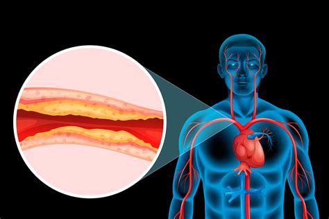 Nuevo método para visualizar placas de aterosclerosis BiotechMN