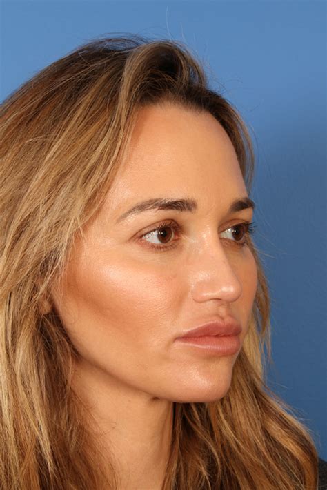 Before And After Rhinoplasty Procedures In Tampa Fl Farrior Facial