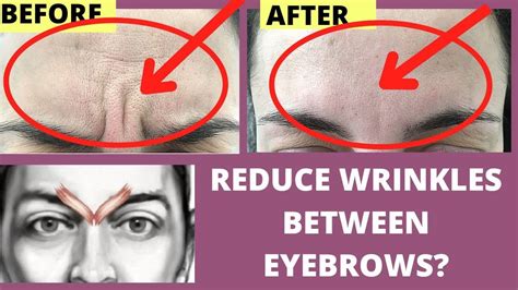 How To Get Rid Frown Lines Reduce Wrinkles Between Eyebrows Naturally Face Yoga Massage