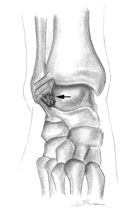 Mr Imaging Of Ankle Impingement Syndromes Ajr