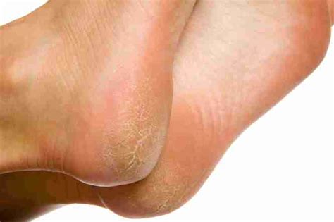 You may notice a white area of skin. Salicylic Acid Plantar Wart Removal Stages | Bruin Blog