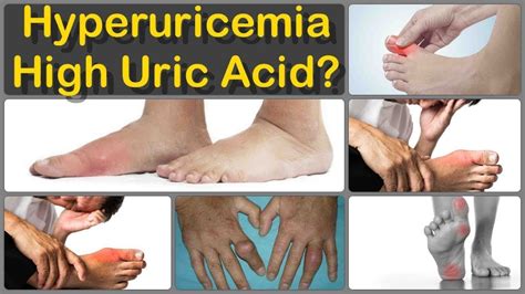 High Uric Acid Symptoms Signs And Symptoms Of High Uric Acid Level In A Body Youtube