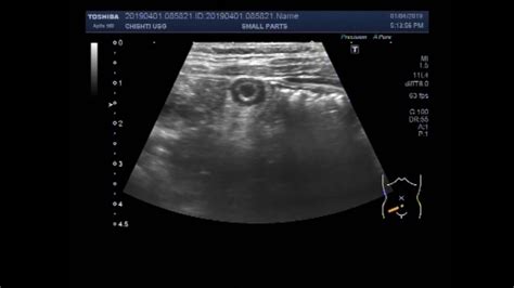 Ultrasound Video Showing A Case Of Inflamed Appendix Youtube