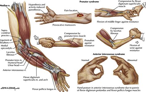 Diagnosis And Treatment Of Work Related Proximal Median And Radial