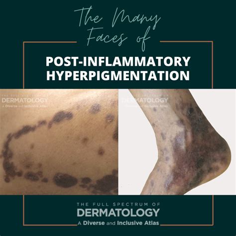 The Many Faces Of Post Inflammatory Hyperpigmentation Pih Next