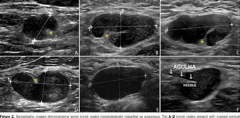 Figure 2 From Axillary Ultrasound And Fine Needle Aspiration In