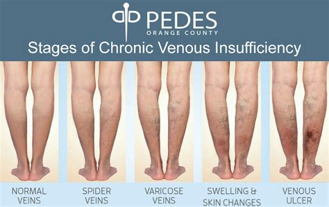 Chronic Venous Insufficiency Treatment Vein Doctor Pedes Oc