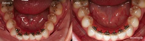 How Long Do Lingual Braces Take Birchgrove Dental
