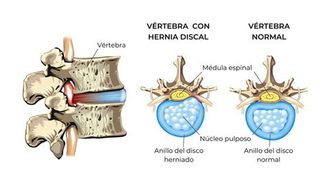 Hernia discal síntomas causas y tratamiento Neurocirujano Sevilla 2022