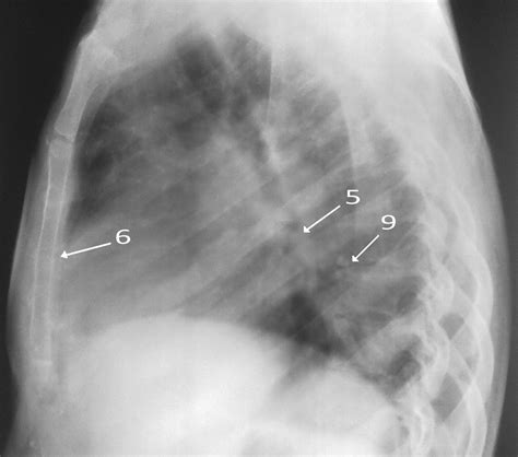 Chronic Mitral Stenosis Circulation