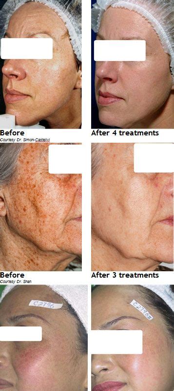 Look Younger With Ipl Skin Rejuvenation Laser Skin Treatment Skin