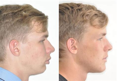 Case 3 Lower Jaw Surgery And Genioplasty Sydney Oral And Facial Surgery