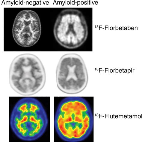Signs And Artifacts In Amyloid Pet Radiographics