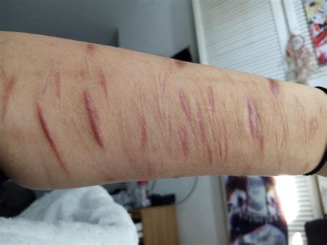 Threatened Into Going Clean So Ive Been Clean On My Arms For Almost 2