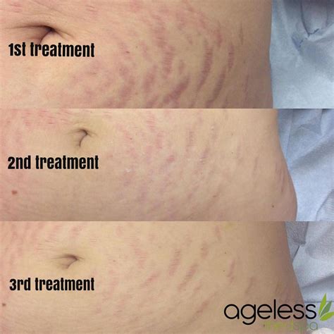 Laser Stretch Mark Removal Does It Really Work