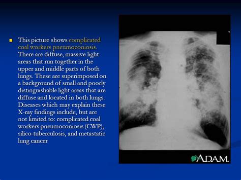 Asbestosis Chest X Ray Findings