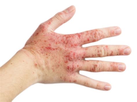 Topical Timolol For Recalcitrant Hand Eczema Dermatology Advisor