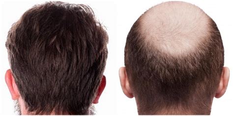 What Are The Highlighted Benefits Of Fue Hair Transplant