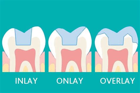 Inlays And Onlays Happy Smile Dental Clinic