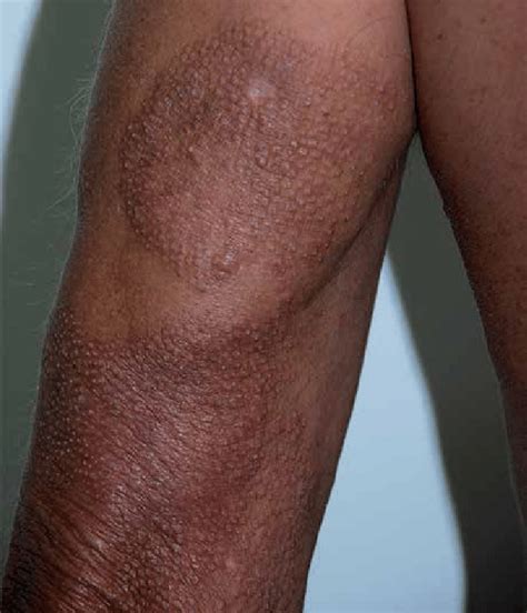 Erythematous Infiltrated Lesions With Follicular Papulae On The Skin Of