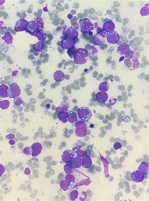 Hematologia Vhebron On Twitter Bone Marrow Infiltration By Diffuse