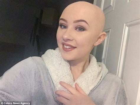 teenager who started going bald aged six ditches her wig daily mail online