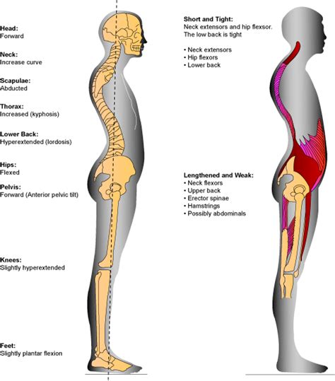 Posture Why Is It Sooo Important Scoliosis Exercises Kyphosis