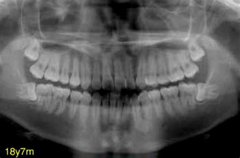Clinical Cases The Wisdom Of Managing Wisdom Teeth Lower 2nd Molars