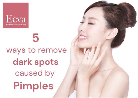 5 Practical Tips On How To Remove Dark Spots Caused By Pimples Eeva