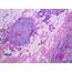 Pathology Outlines  Carcinoid Tumor
