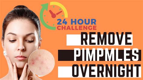 24 Hours Challenge How To Get Rid Of Pimples In Just One Day How To