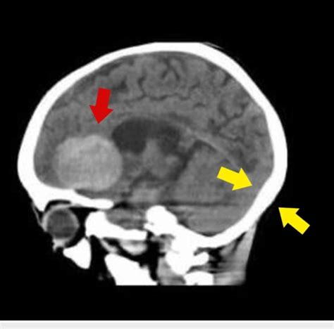 Ct Scan Brain Showing A Large Right Frontal Lobe Hemorrhage Red Arrow